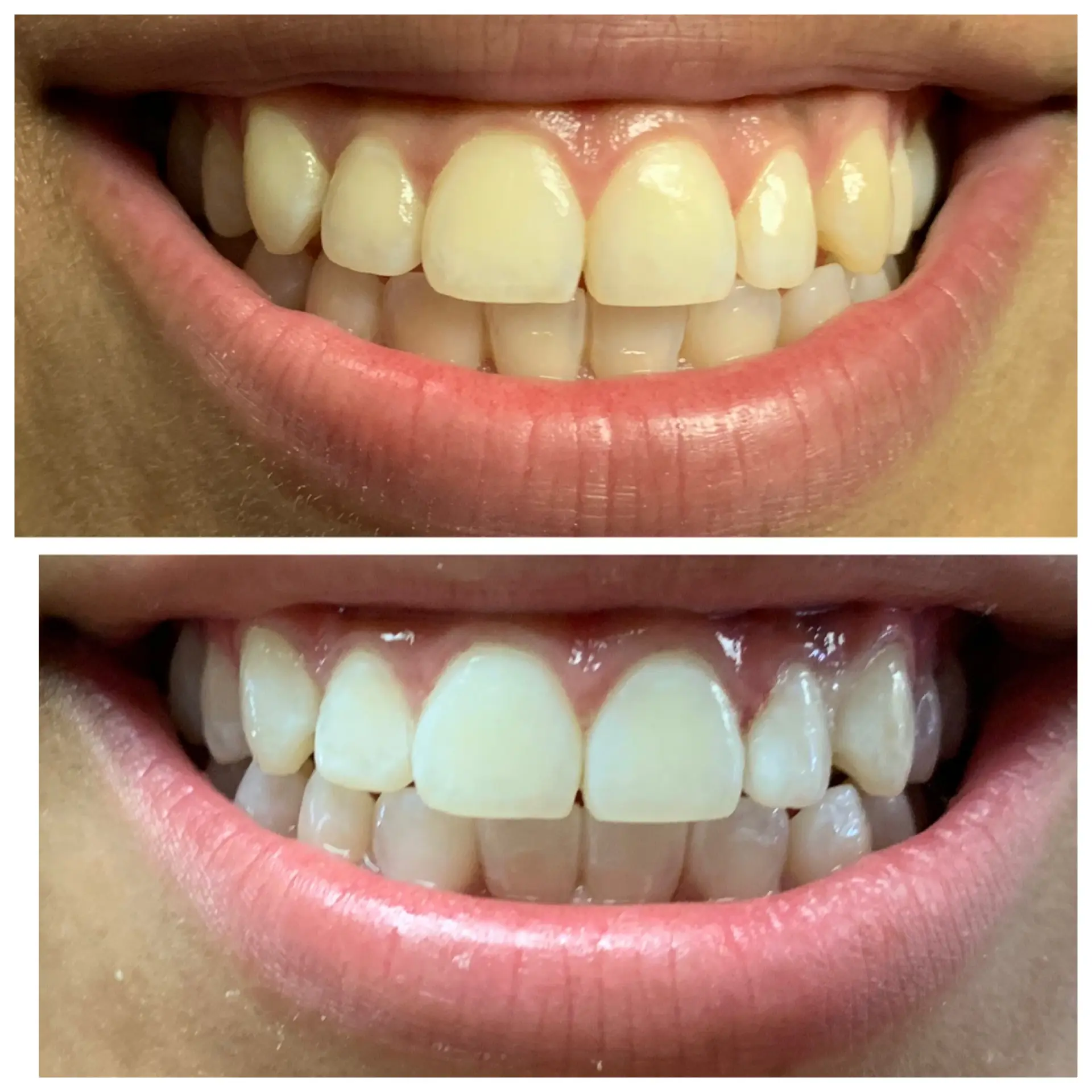 Blanqueamiento Dental